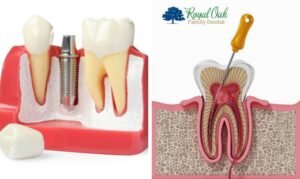 root canal vs implant pros and cons