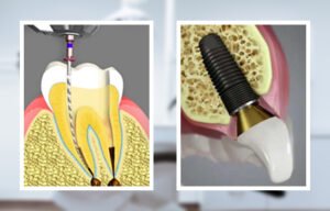 root canal vs implant pros and cons