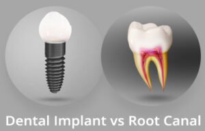 root canal vs implant pros and cons