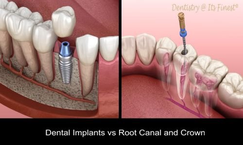 Root Canal vs Implant Pros and Cons: Which is Better for Your Teeth?